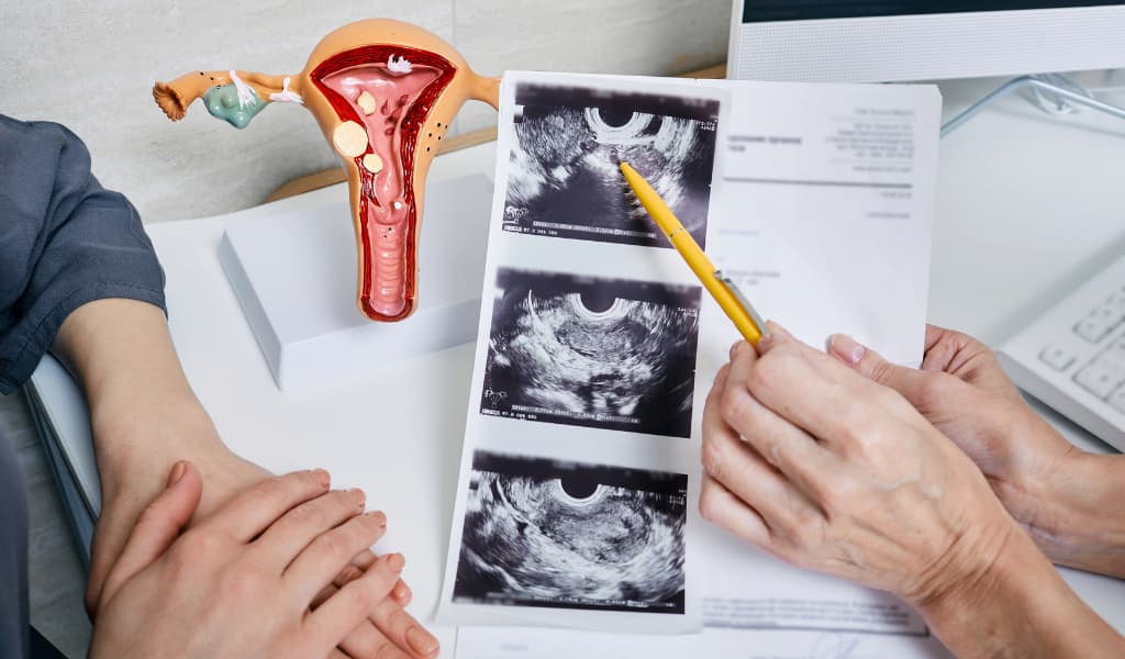 Polikistik Over Sendromunda Doğal Yollar İle Hamile Kalınır Mı?