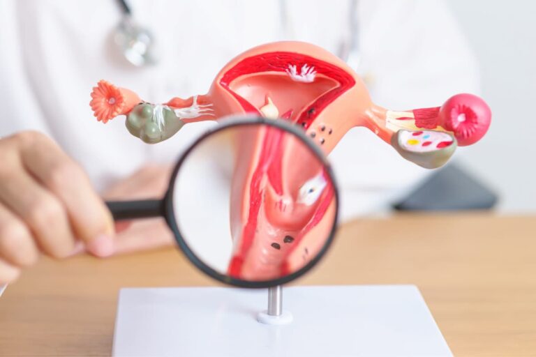 Polikistik Over Sendromu (PCOS) Nedir?